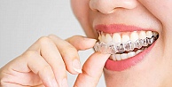 Şeffaf Plak Tedavisi (Invisalign) Hakkında Merak Edilenler